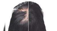 Discover Effective Home Remedies to Combat Alopecia and Hair Loss!