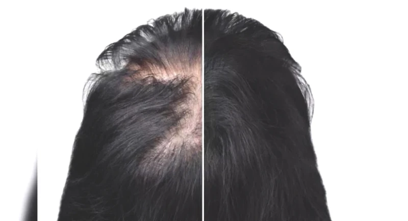 Discover Effective Home Remedies to Combat Alopecia and Hair Loss!